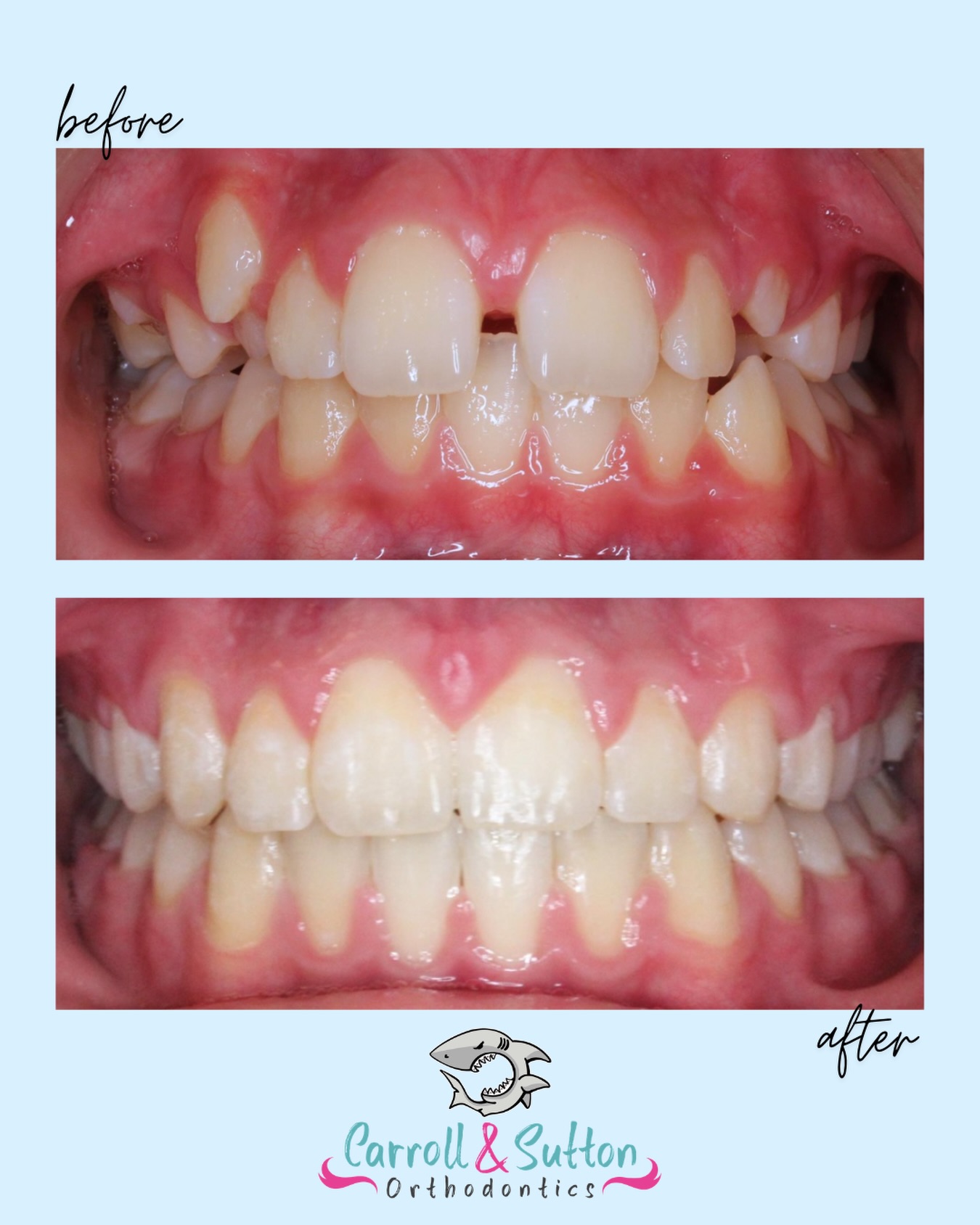✨ From start to finish…what a transformation! ✨
Seeing this smile transform is one of the many reasons we love what we do 🩵 Ready for your smile glow up? We’ve got you! 🦷
#BracesTransformation #BeforeandAfter #SmileTransformation #Braces #CarrollandSuttonOrthodontics