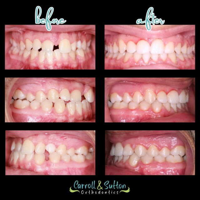 This before and after transformation speaks for itself! This patient presented with an anterior crossbite, a class II bite, upper and lower spacing, and a heavy upper frenum. Dr. Sutton placed upper and lower braces on him to correct his bite, close the spacing, and create a healthy, functional, and confident smile 😊
#BeforeandAfter #SmileTransformation #SmileinStyle #Orthodontics #CarrollandSuttonOrthodontics