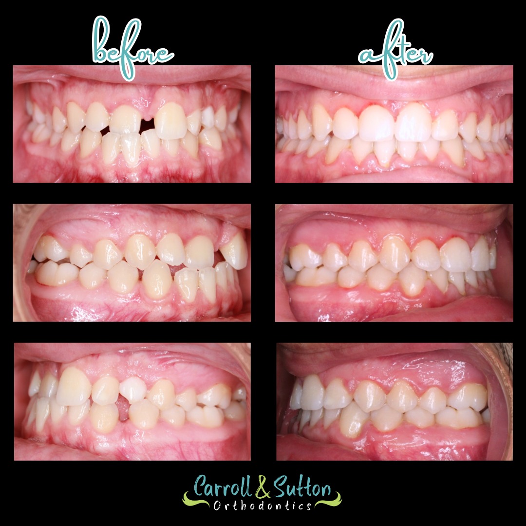 This before and after transformation speaks for itself! This patient presented with an anterior crossbite, a class II bite, upper and lower spacing, and a heavy upper frenum. Dr. Sutton placed upper and lower braces on him to correct his bite, close the spacing, and create a healthy, functional, and confident smile 😊
#BeforeandAfter #SmileTransformation #SmileinStyle #Orthodontics #CarrollandSuttonOrthodontics
