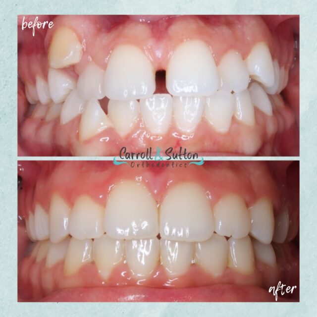 This patient presented with diastema (spacing between 2 teeth) and had a crossbite. Dr. Sutton placed braces on her upper and lower arch and the patient wore elastics to correct the spacing and improper bite. Now, she can show off her stunning smile in style!

 Ready to start your smile journey? Call us at 941-257-2000 for your complimentary consultation! We can’t wait to see you! 🦷✨ 

#Braces #SouthwestFlorida #Orthodontics #BeforeandAfter #SmileTransformation