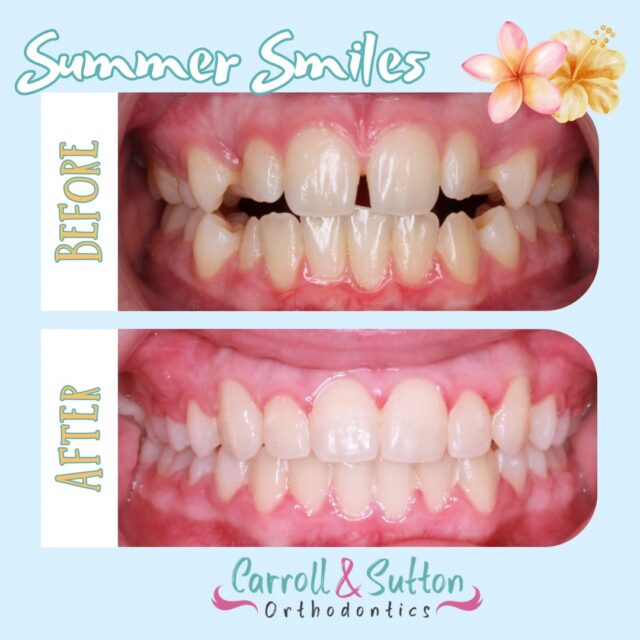 ☀️🌴 Surfs up for your dream summer smile! 🌊🏖️

From before ➡️ to after ✨, this smile transformation is giving us all the sunshine vibes 🌞 We love seeing our patients hard work pay off with beautiful results that will last long after summer ends 🩵

Thinking about starting your own smile journey? Give us a call today to schedule your complimentary consultation and let’s make this your summer to smile! 🤩☀️

#Braces #SouthwestFloridaOrthodontist #SummerSmile #Aligners #SmileTransformation