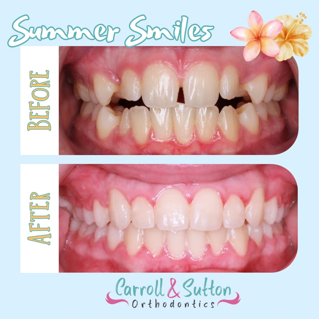☀️🌴 Surfs up for your dream summer smile! 🌊🏖️

From before ➡️ to after ✨, this smile transformation is giving us all the sunshine vibes 🌞 We love seeing our patients hard work pay off with beautiful results that will last long after summer ends 🩵

Thinking about starting your own smile journey? Give us a call today to schedule your complimentary consultation and let’s make this your summer to smile! 🤩☀️

#Braces #SouthwestFloridaOrthodontist #SummerSmile #Aligners #SmileTransformation
