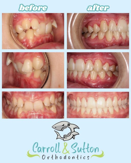 ✨ What a transformation! ✨

Every smile is unique, and we're so excited to celebrate this amazing result! 😁🦷

Ready to start your own smile journey? We offer FREE consultations! Give us a call to schedule yours today! 💙

📞 941-257-2000

#SmileTransformation #BeforeAndAfter #Orthodontics #Braces #ClearAligners #FreeConsultation