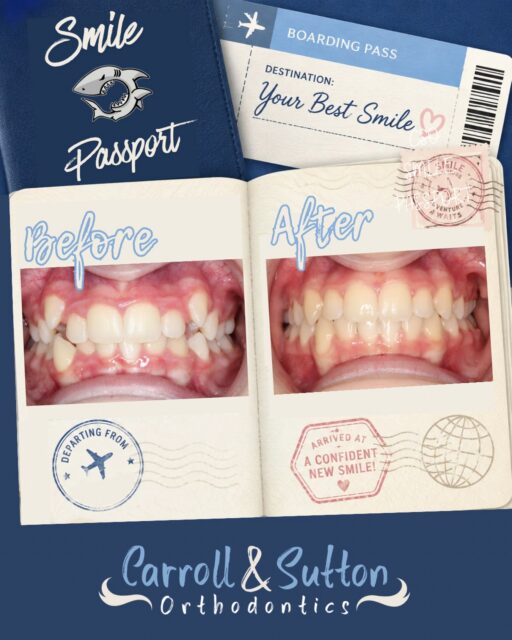 ✈️ Next Stop: New Smile! 😁

This is a smile journey worth stamping! 🌎✨ From the first appointment to the final reveal, this smile has officially arrived at its final destination! 🧳🦷
🤙🏼 Book your complimentary consultation today to start your smile adventure! 

#Orthodontics #SmileReveal #BeforeandAfter #SmileTransformation #SouthwestFloridaOrthodontist