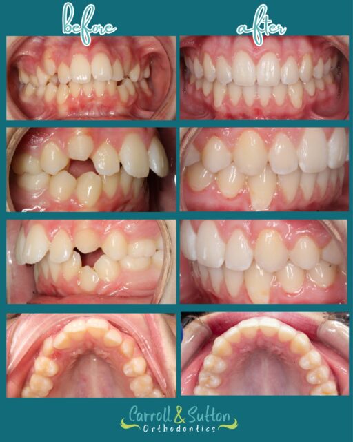 From where we started to where we are now! 🦷✨

This before & after is proof that great things happen one appointment at a time. Congratulations on your beautiful new smile! 💗

#CarrollAndSuttonOrthodontics #SmileReveal #BeforeAndAfter #OrthodonticTreatment