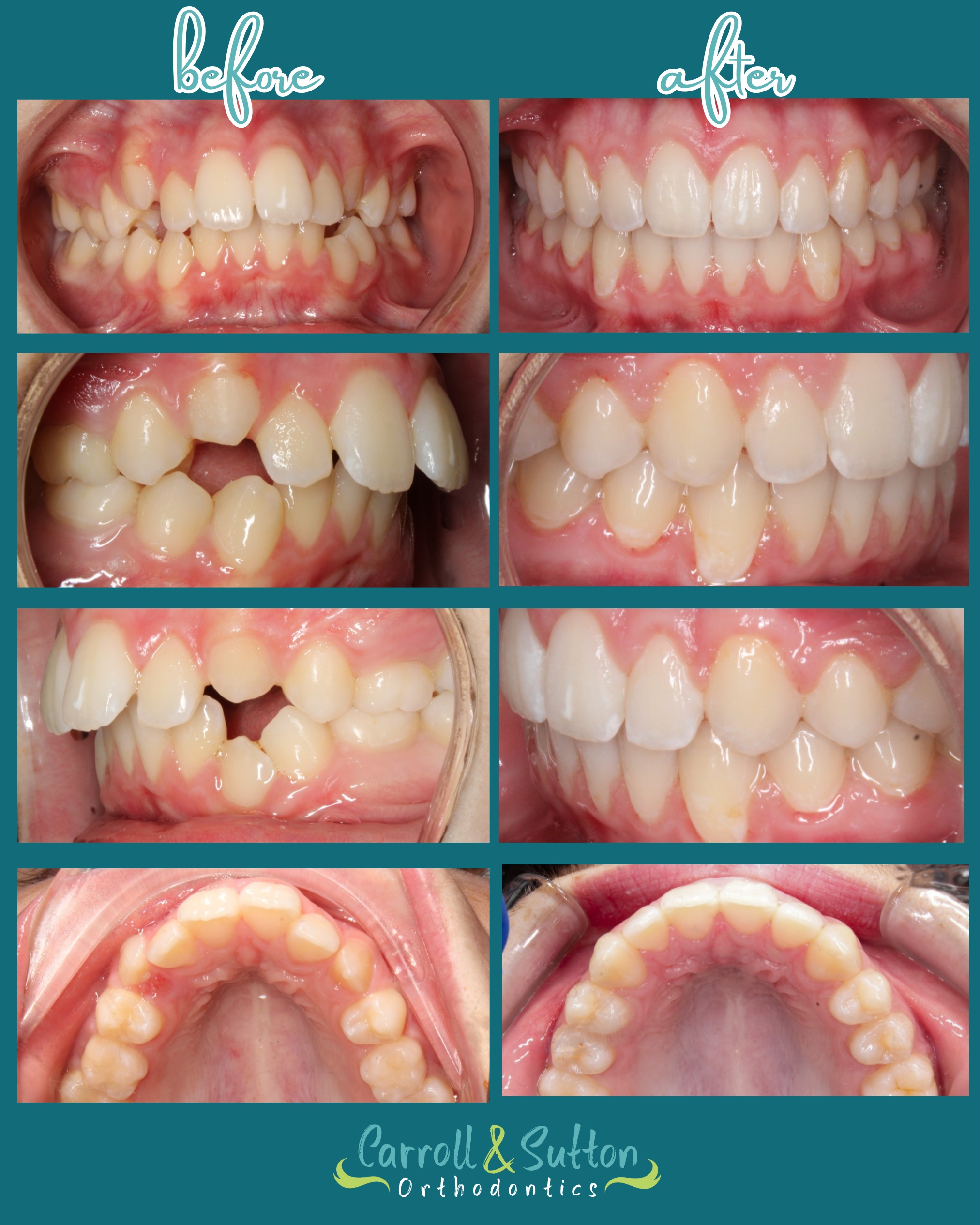 From where we started to where we are now! 🦷✨

This before & after is proof that great things happen one appointment at a time. Congratulations on your beautiful new smile! 💗

#CarrollAndSuttonOrthodontics #SmileReveal #BeforeAndAfter #OrthodonticTreatment