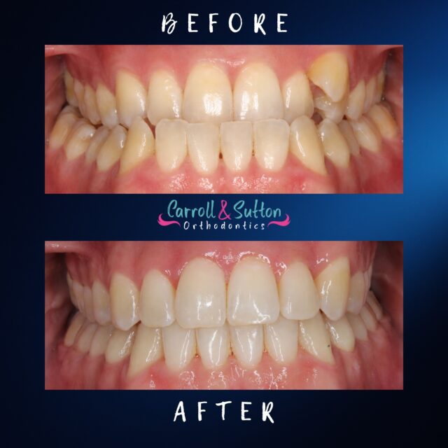 What a transformation! A beautiful before & after smile we’re so excited to celebrate! 😁🦷

#orthodontics #fypシ❤️💞❤️ #carrollandsutton #ortho #beforeandafter #transformation