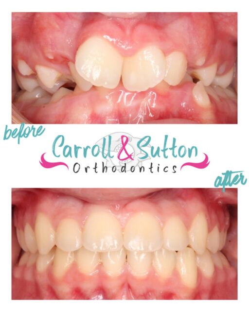 This patient presented with a class II bite, severe overjet and crowding, and constricted upper and lower arch widths. She was placed in braces where we leveled and aligned her teeth. The result? A beautiful new smile! 😁
Ready for your new smile? Call us for a complimentary consultation! 🦷
📍 North Port, Venice, Sarasota, Lakewood Ranch
☎️ 941-257-2000
#southwestflorida #orthodontics #freeconsultation #braces #aligners