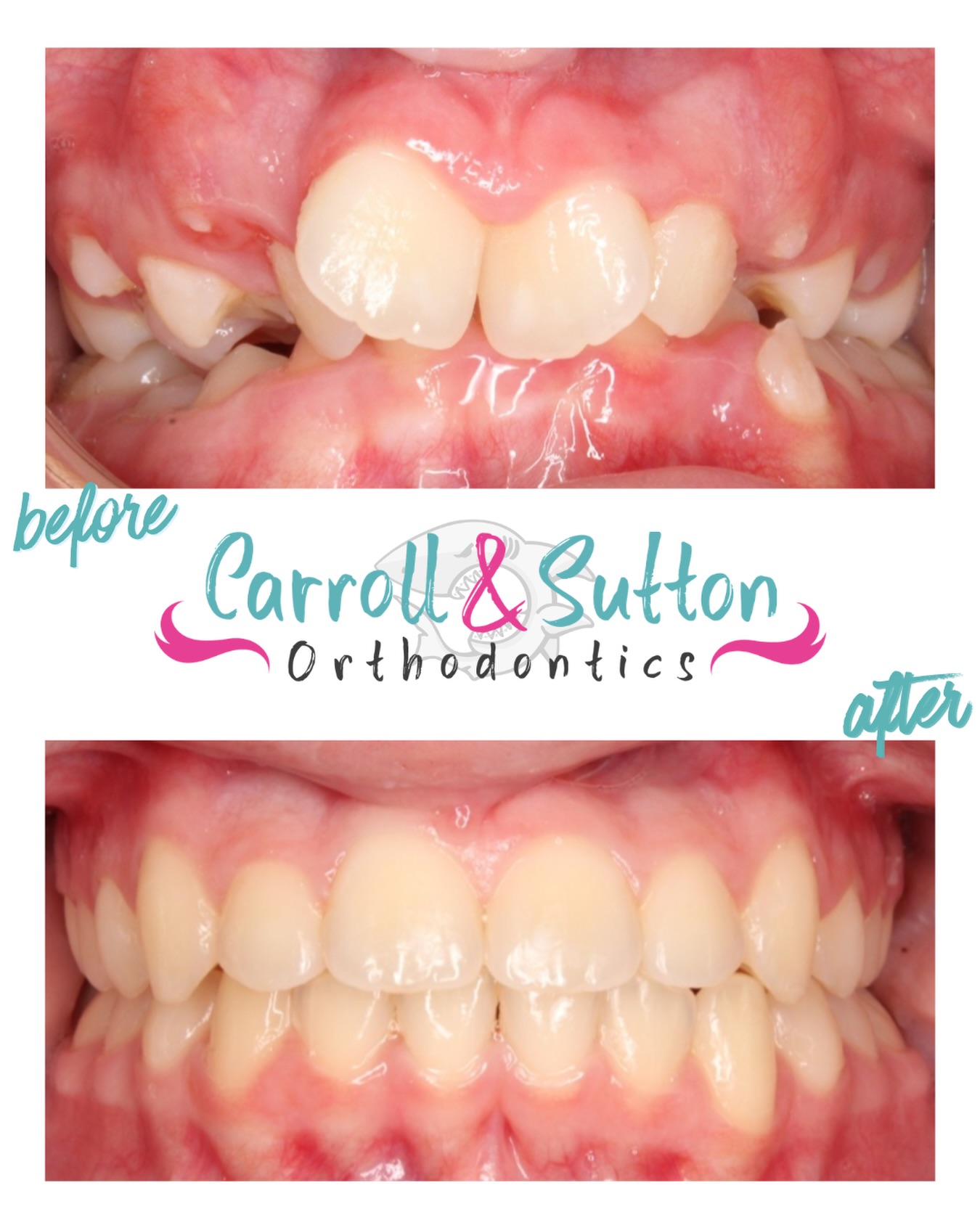 This patient presented with a class II bite, severe overjet and crowding, and constricted upper and lower arch widths. She was placed in braces where we leveled and aligned her teeth. The result? A beautiful new smile! 😁
Ready for your new smile? Call us for a complimentary consultation! 🦷
📍 North Port, Venice, Sarasota, Lakewood Ranch
☎️ 941-257-2000
#southwestflorida #orthodontics #freeconsultation #braces #aligners