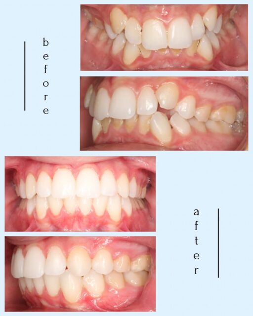 Before → after braces treatment 🦷✨
To unlock your dream smile, give us a call at 941-257-2000! 

#BeforeandAfter #SmileTransformation #Orthodontics #SouthwestFlorida