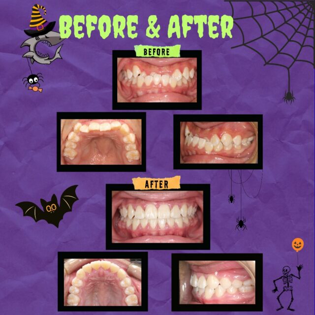 🎃👻 No Tricks, Just BOO-tiful Smiles! 🦷✨
This smile transformation is SPOOK-tacular! 🕷️🦇
From a spooky BEFORE to a fang-tastic AFTER, there’s nothing scary about these results! 😁
At Carroll & Sutton Orthodontics, we’re making scary smiles disappear one patient at a time! 🎃💜
#CarrollSuttonOrthodontics #SpooktacularSmiles #BeforeAndAfter #SmileTransformation #HalloweenSmiles #BracesOff