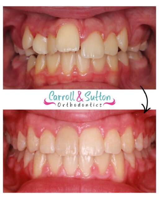 Transformation Thursday 💫
This smile says it all! Results like this make it all worth it!
Call us today for your complimentary consultation and we can make your smile dreams comes true 😁
📞 941-257-2000
📍 North Port, Venice, Sarasota, Lakewood Ranch