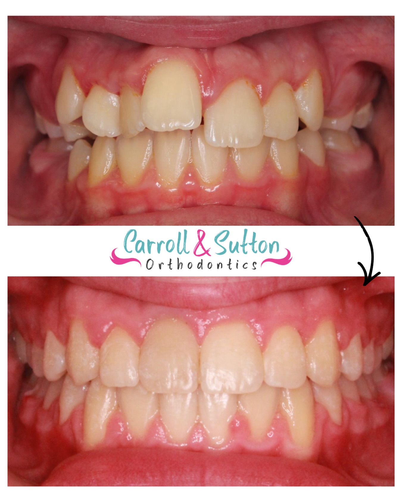 Transformation Thursday 💫
This smile says it all! Results like this make it all worth it!
Call us today for your complimentary consultation and we can make your smile dreams comes true 😁
📞 941-257-2000
📍 North Port, Venice, Sarasota, Lakewood Ranch
