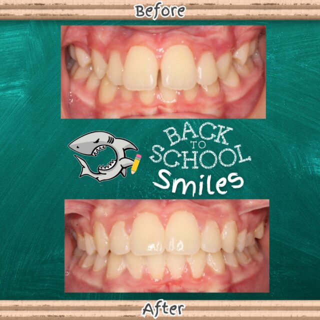 ✏️ First day of school? Ready ✅
🎒 New supplies? Ready ✅
😁 New smile? READY! ✅
This transformation is the perfect way to start a brand-new school year. ✨
#BackToSchoolSmile #SmileTransformation #CarrollandSuttonOrthodontics #Braces #BeforeandAfter
