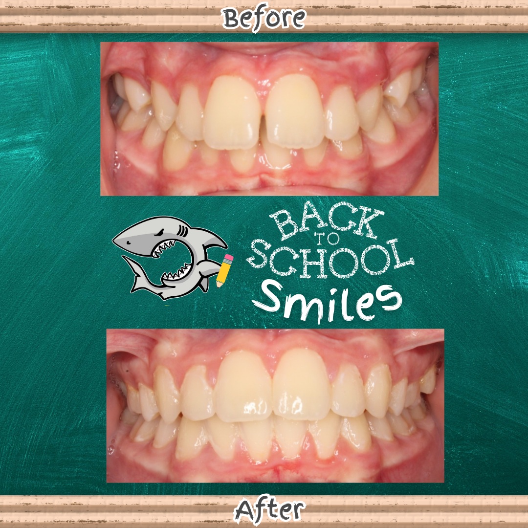 ✏️ First day of school? Ready ✅
🎒 New supplies? Ready ✅
😁 New smile? READY! ✅
This transformation is the perfect way to start a brand-new school year. ✨
#BackToSchoolSmile #SmileTransformation #CarrollandSuttonOrthodontics #Braces #BeforeandAfter