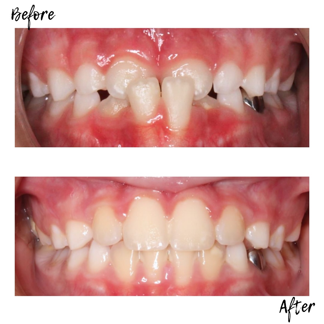 Before ➡️ After — what a difference! 😁🦷
Check out this amazing transformation! ✨
#OrthodonticTransformation #BracesOff #SmileGoals #BeforeAndAfter #NewSmile #SmileMakeover #CarrollandSuttonOrthodontics #Orthodontics 😁📸🦷
