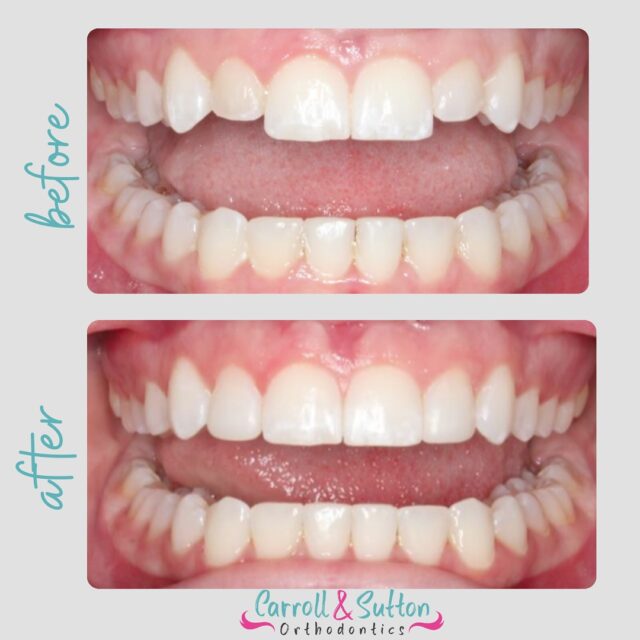 🦷✨Before & After ✨🦷
This transformation focuses on the upper lateral incisors! Upper lateral incisors are the most commonly missing or misshapen teeth. They are often small and disproportionate to the other teeth. After this teen’s orthodontic treatment was completed, her small upper lateral incisors were lengthened with resin composite bonding.
#beforeandafter #carrollandsuttonorthodontics #smiletransformation