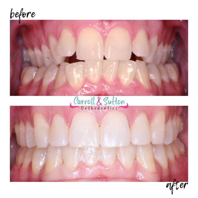 The photos say it all 😄📸 The power of a smile transformation is truly life changing! 🦷
#carrollandsuttonorthodontics #cso #braces #beforeandafter #smiletransformation #orthodontics