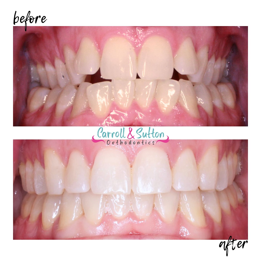 The photos say it all 😄📸 The power of a smile transformation is truly life changing! 🦷
#carrollandsuttonorthodontics #cso #braces #beforeandafter #smiletransformation #orthodontics