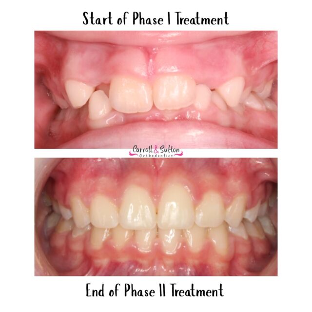 This 9yr old patient presented with the following:
🦷A deep overbite, where the upper front teeth cover too much of the lower teeth
🦷A crossbite in the front, meaning one or more lower front teeth sit in front of the upper front teeth when biting
🦷Crowding, where there isn’t enough space for the teeth to line up properly
🌟Now, they have the smile they have always dreamed of!
📞 Call us today for your dream smile! ✨ Consultations are complimentary!
#csorthodontics #smiletranformation #braces #beforeandafter #dreamsmile #orthodontics #orthodontistoffice