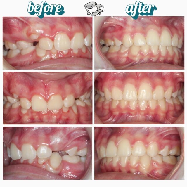 Before Braces On ➡️ Braces gone! 🎉😄 Rocking this brand new smile like a superstar 🌟💫 #SmileGlowUp #ByeBraces #Orthodontics #Orthodontist #Braces #SmileGoals #SmileTransformation #SmileBeforeandAfter #CarrollandSuttonOrthodontics