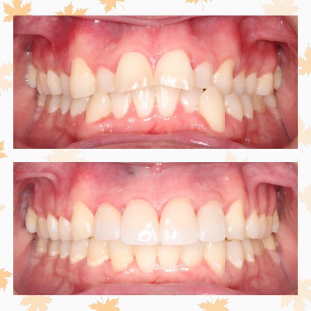 Before ➡️ After 🤩
This patient wanted to correct the wear and misalignment of his front teeth. We corrected his alignment and bite, leaving proper spacing for his dentist to then restore his upper front teeth. His dentist did a beautiful job on his veneers and he loves his new smile! 😁🦷

#CSOrthodontics #Braces #Aligners #RestorativeWork #Dentist #Orthodontist #BeforeandAfter #SmileTransformation #SmileBeforeandAfter #AmazingSmile