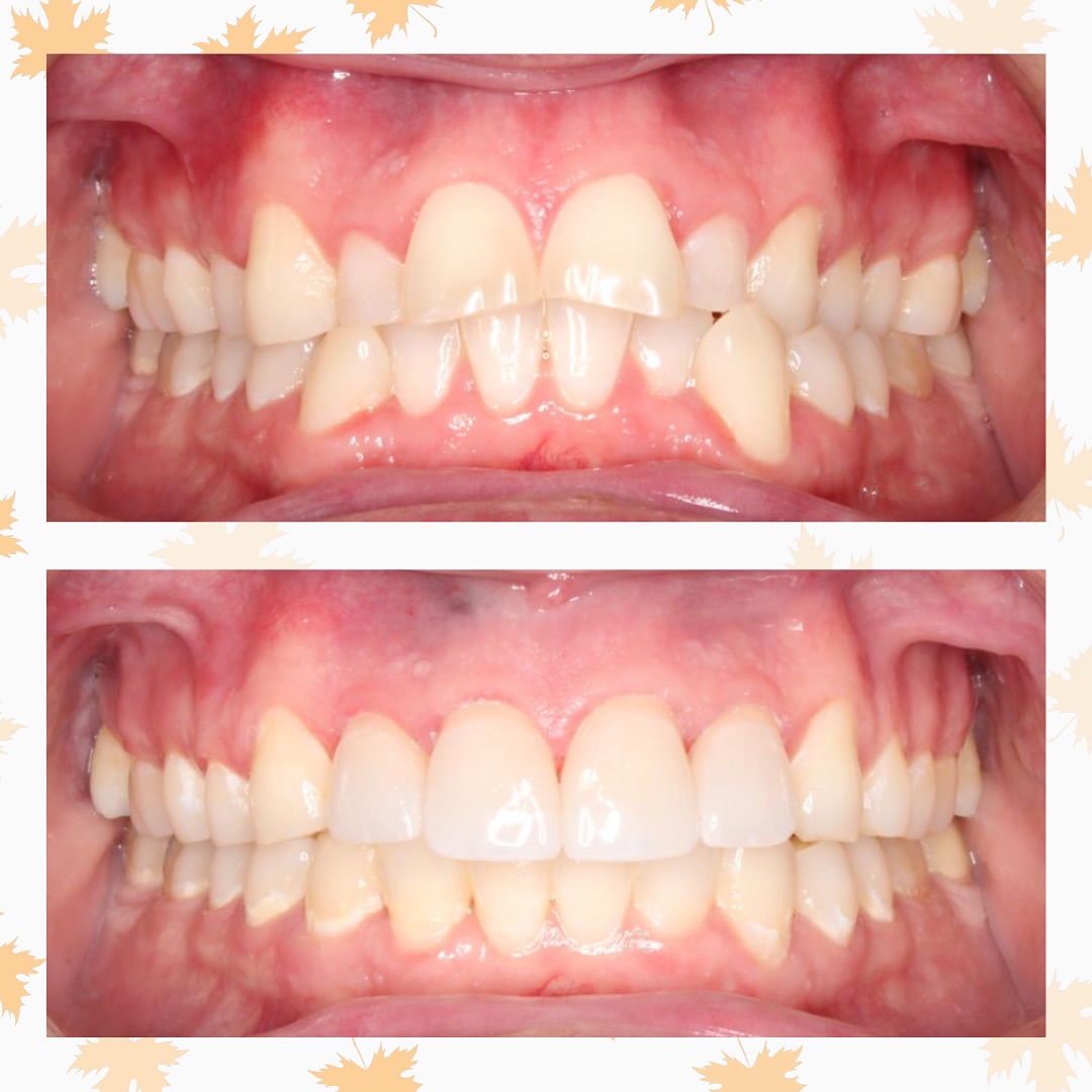 Before ➡️ After 🤩
This patient wanted to correct the wear and misalignment of his front teeth. We corrected his alignment and bite, leaving proper spacing for his dentist to then restore his upper front teeth. His dentist did a beautiful job on his veneers and he loves his new smile! 😁🦷

#CSOrthodontics #Braces #Aligners #RestorativeWork #Dentist #Orthodontist #BeforeandAfter #SmileTransformation #SmileBeforeandAfter #AmazingSmile