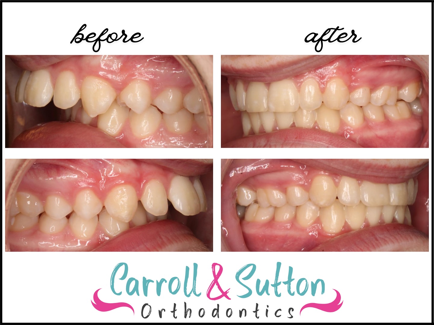 This patient presented with an excessive overbite. We placed upper and lower braces on him, and his smile is now stunning! To schedule a complimentary consultation for your dream smile, call us today at 941-257-2000! ☎️😄

#BeforeandAfter #CarrollandSuttonOrthodontics #Orthodontist #Braces #Overbite #SmileTransformation #OrthodontistOffice